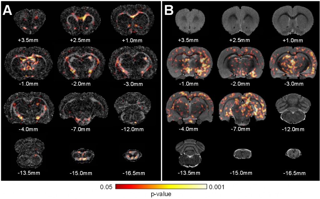 Diffusion and magnetization transfer MRI of diffuse TBI.