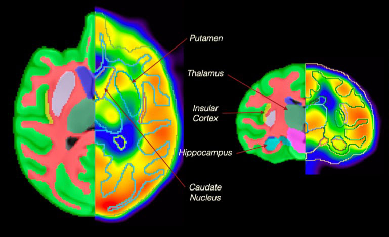 Baboon brain atlas in Axial Coronal View